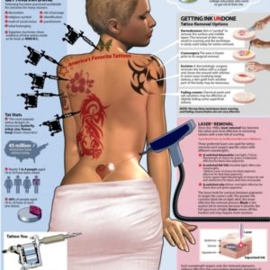 How to Get Rid of a Tattoo