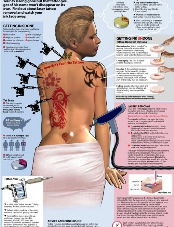 How to Get Rid of a Tattoo