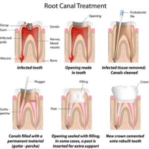 Root Canal Treatment Milton – Oasis Dental Milton
