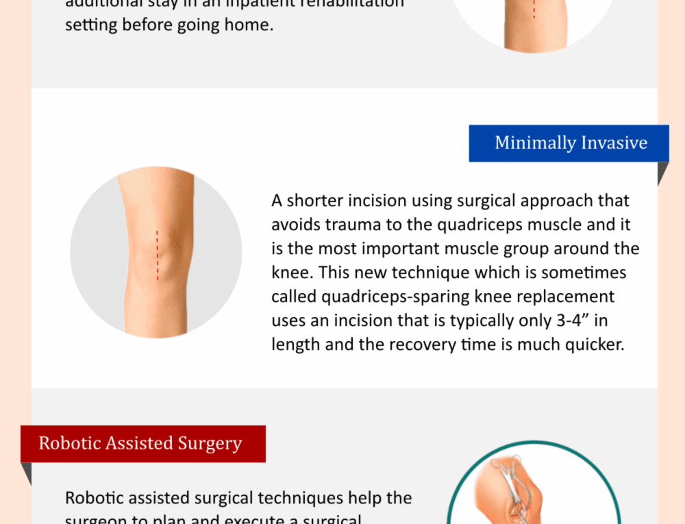 10-Minute Guide to Knee Replacement