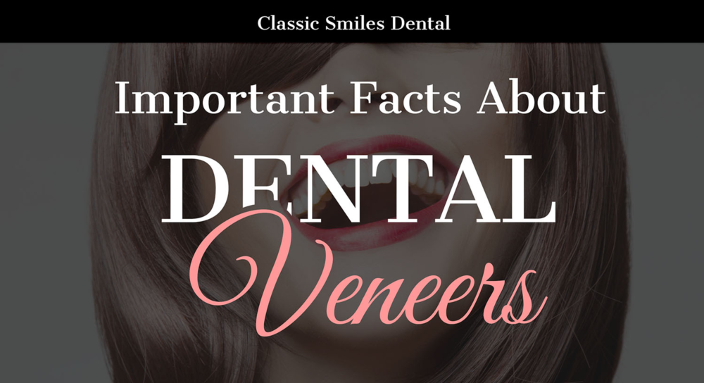 Important Facts About Dental Veneers