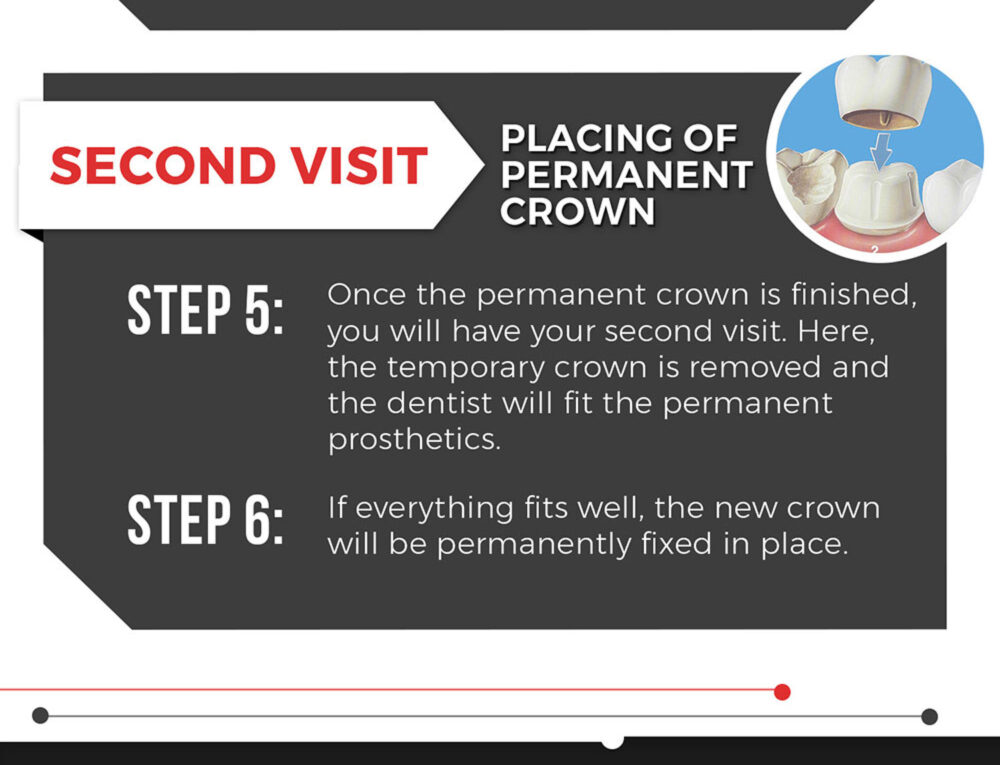 Everything You Need To Know About Dental Crowns